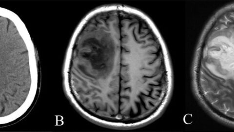 CT and MRI scan of the brain with melioidosis