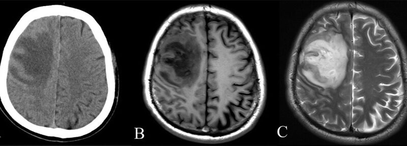 CT and MRI scan of the brain with melioidosis
