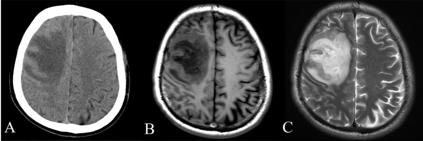CT and MRI scan of the brain with melioidosis