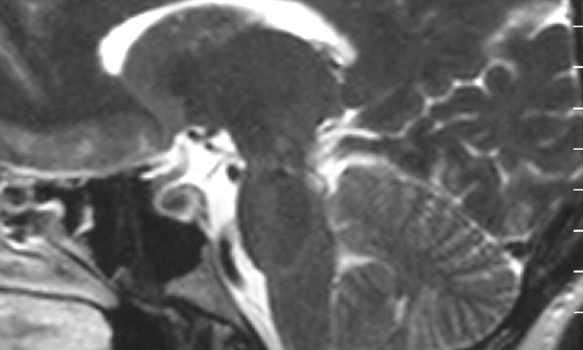 Sagittal MRI scan of brain of patient with Chiari malformation