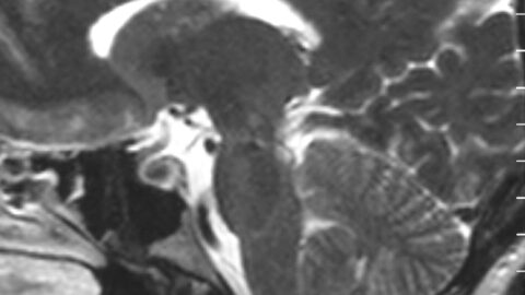 Sagittal MRI scan of brain of patient with Chiari malformation